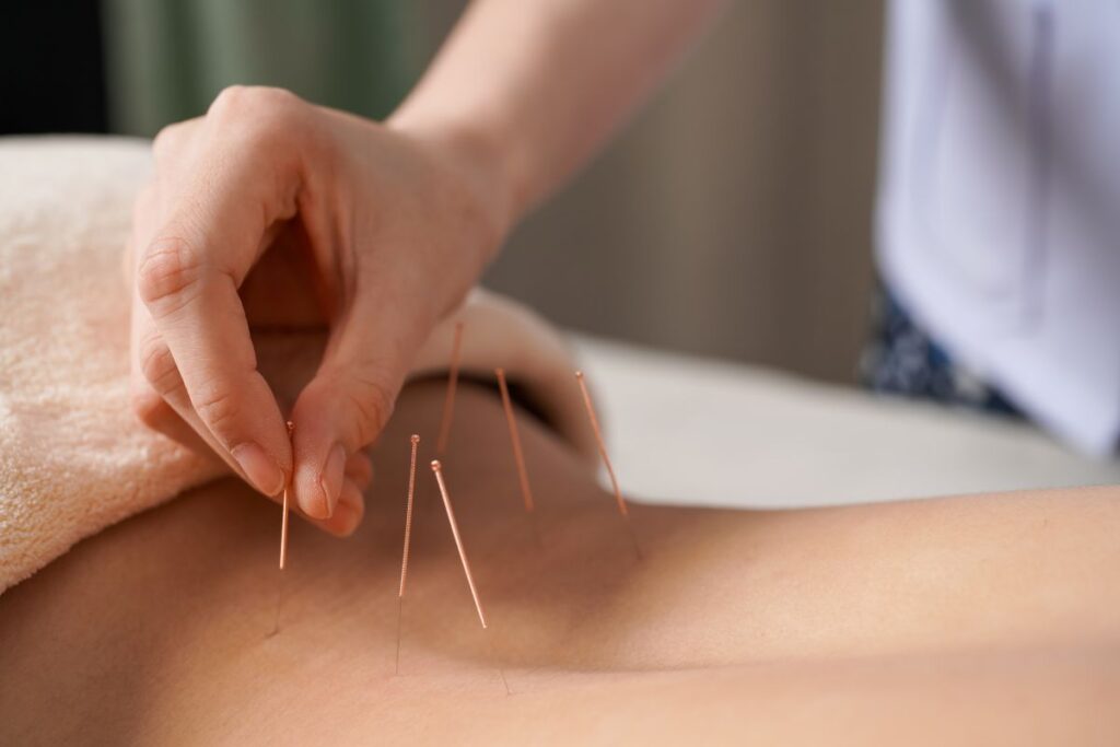 A hand applying needles to a woman's back