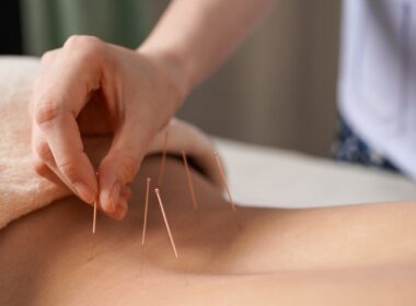 A hand applying needles to a woman's back