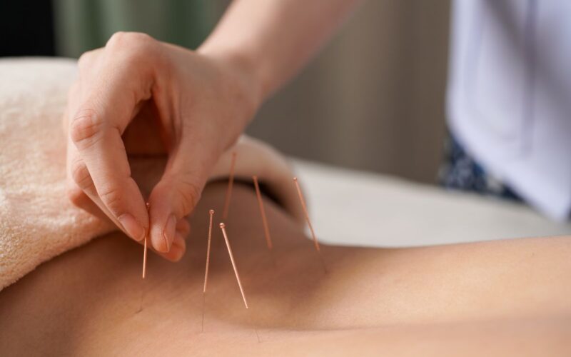A hand applying needles to a woman's back